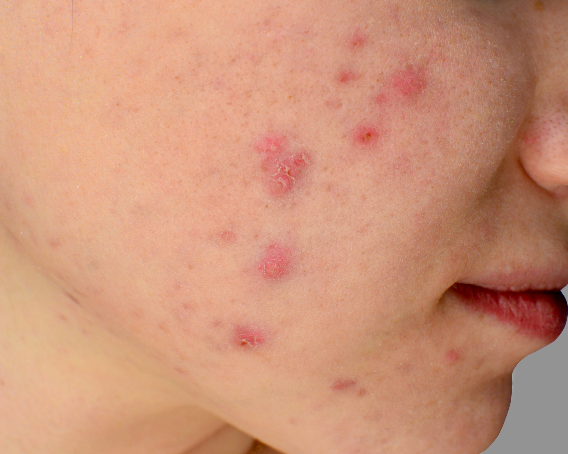 Acne is a common skin condition. At Hazelhill Family Practice we have extensive experience in treating acne.