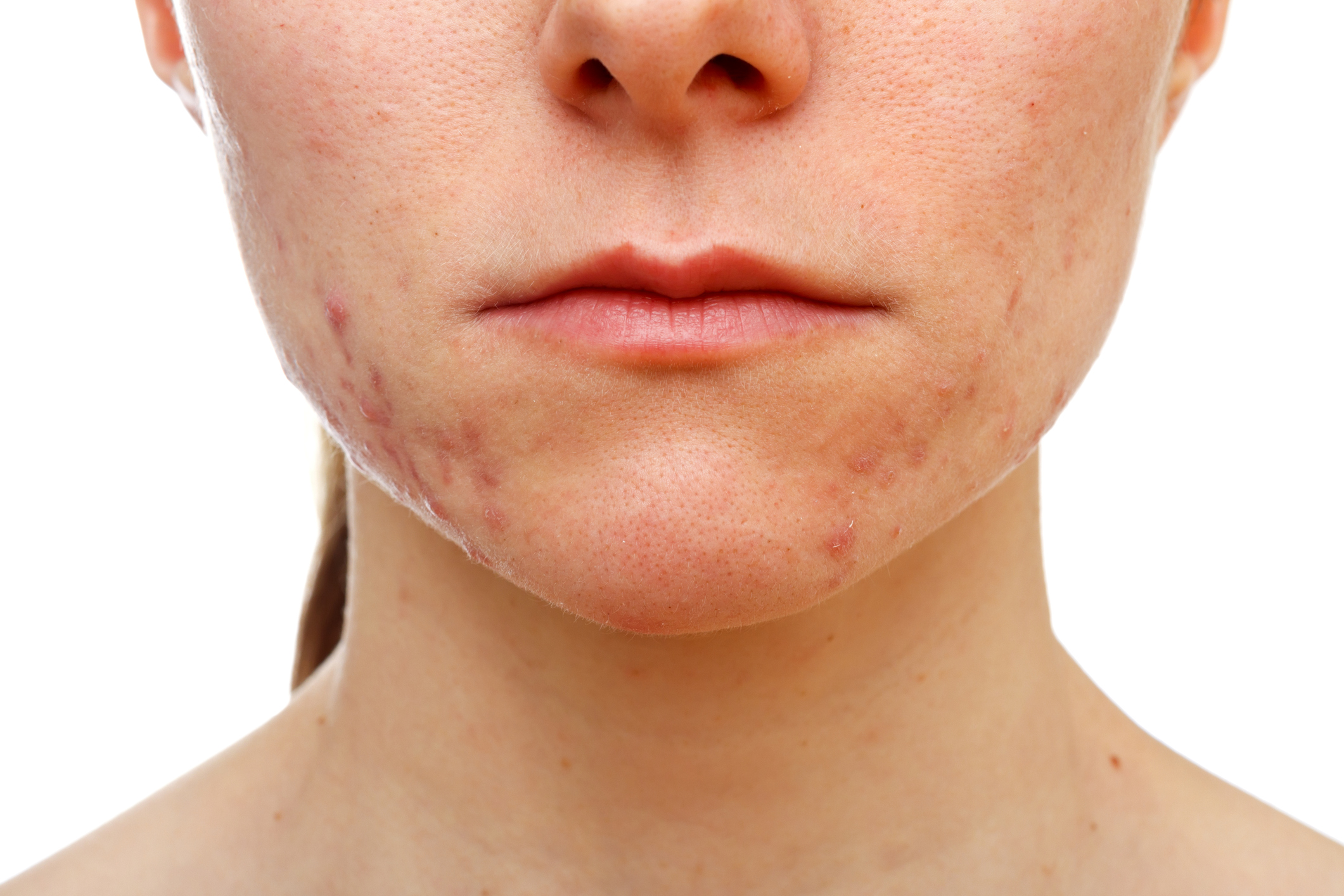 Acne treatment is provided at Hazelhill Family Practice