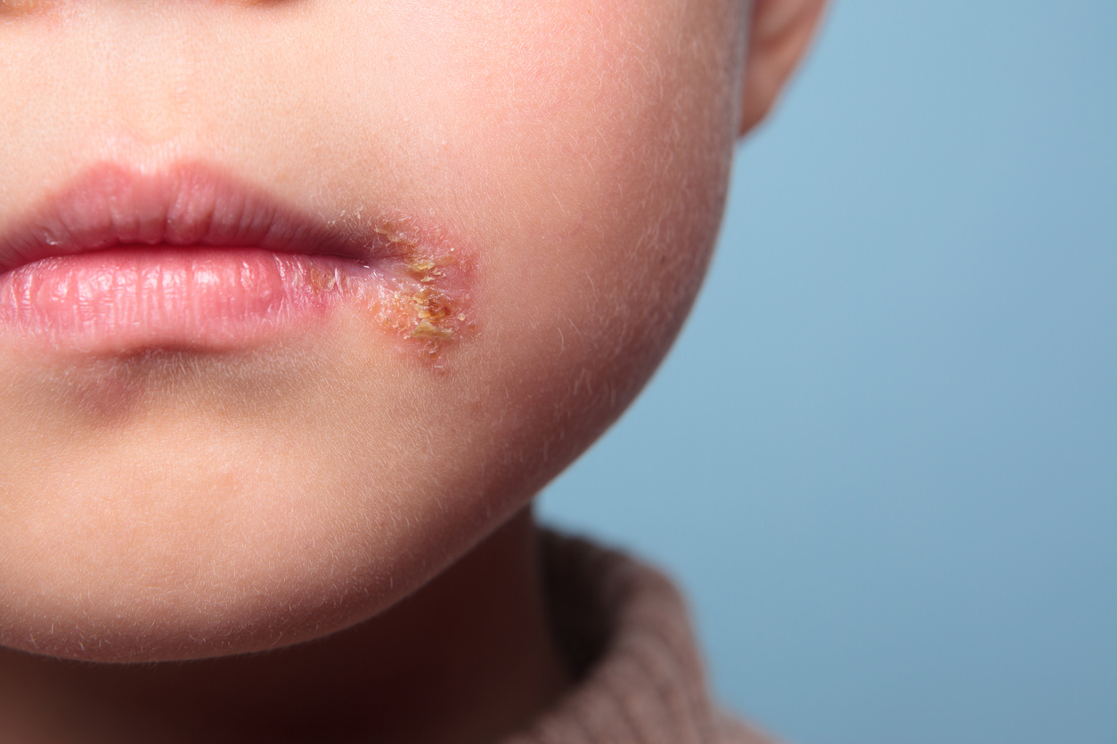 Cold sores and herpes are treated at Hazelhill Family Practice.