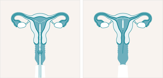 How we fit the Mirena coil at Hazelhill Family Practice